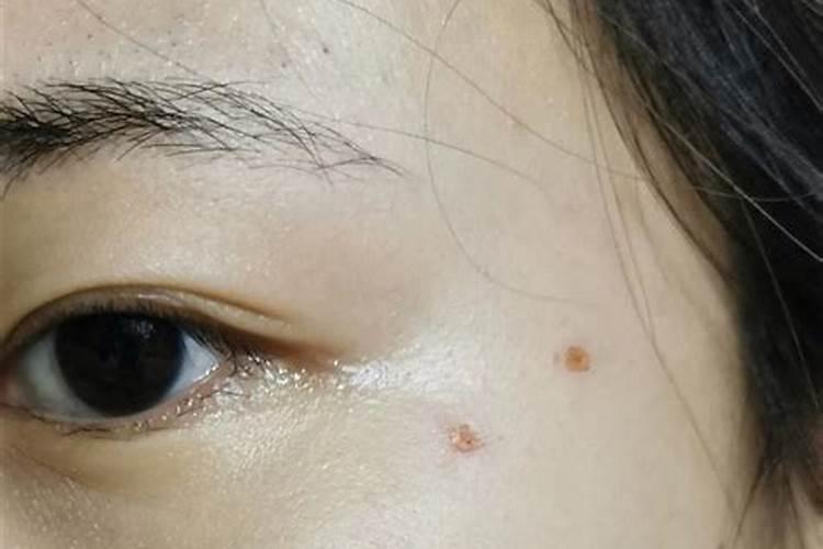 不好的痣点掉会转运吗 能改变命运吗