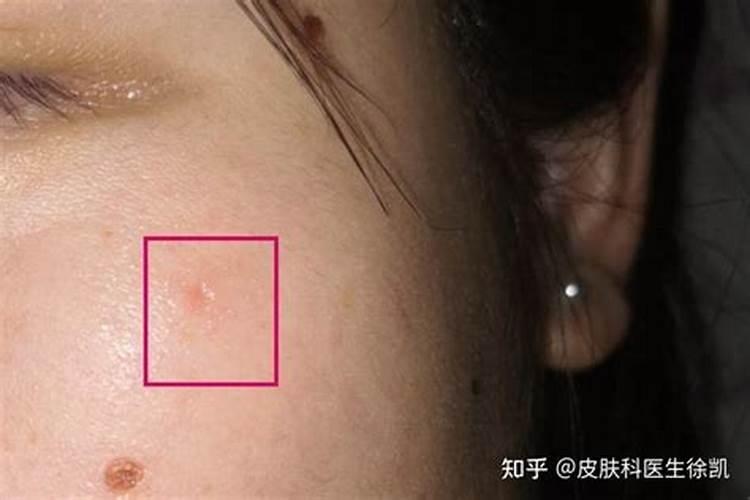 点痣会影响一个人的运气吗