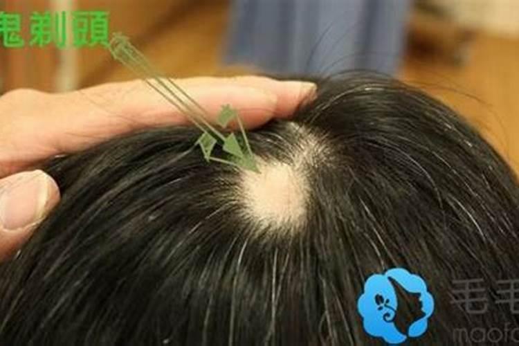 梦见头顶头发掉了秃了一块