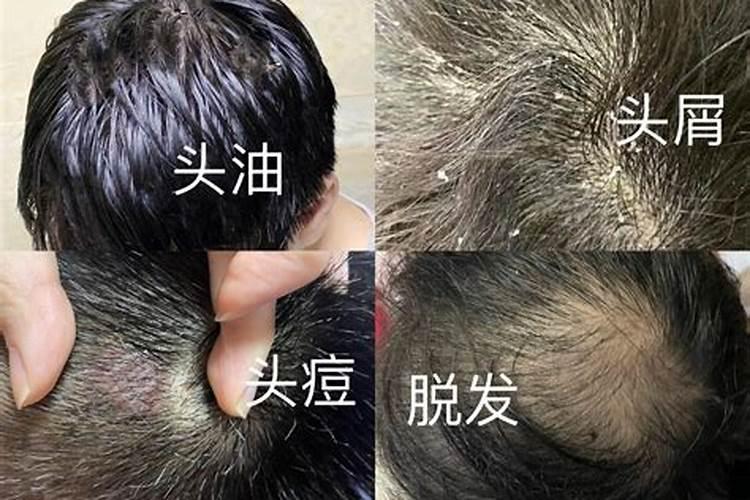 梦见头皮屑成片的往下掉的预兆