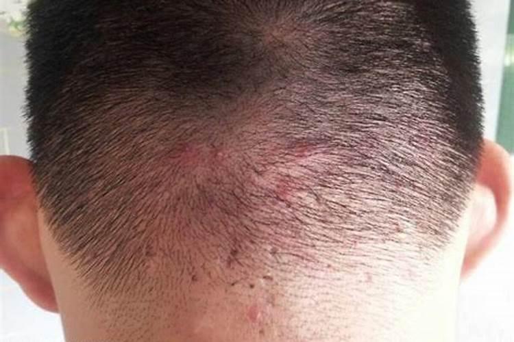 女人梦见头上长虱子是吉兆吗