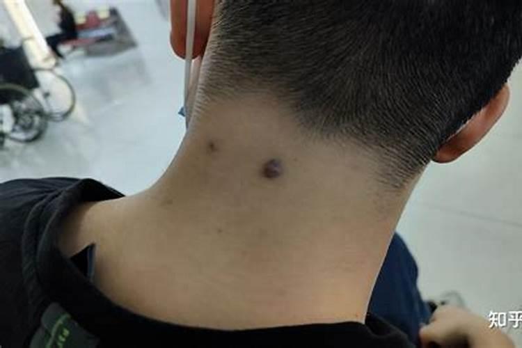 痣的位置与命运 脖子后面有痣的女人好吗