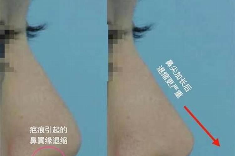 鼻孔外露的男人能不能嫁,会有什么影响？