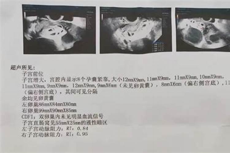 堕胎对人的运势有影响吗