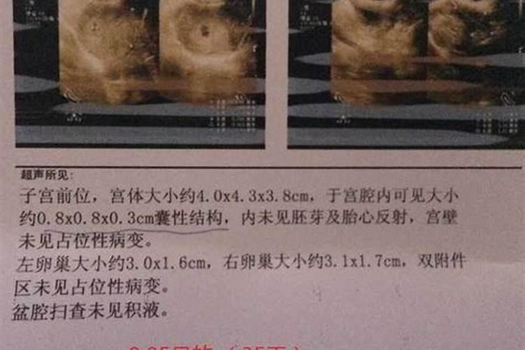人流后例假特别多正常吗