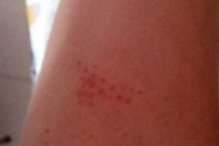 梦见腿上皮肤成红色像是红志