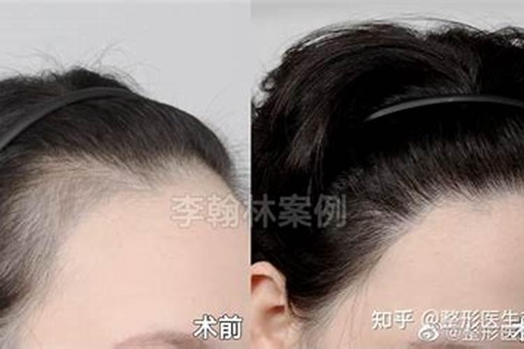 梦见发际线后退