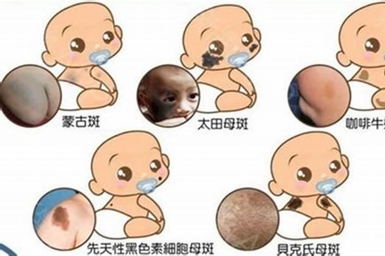 最有福气的10处胎记