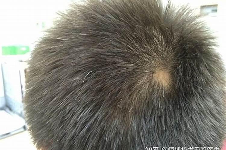 女人梦到掉一大缕头发吉兆