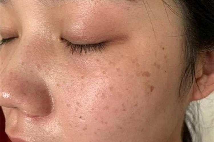 梦到脸上长斑是什么意思