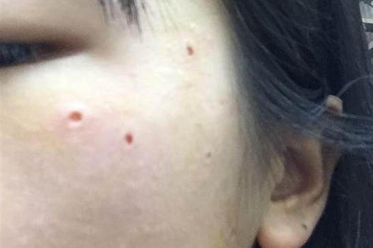 脸上长痣代表什么