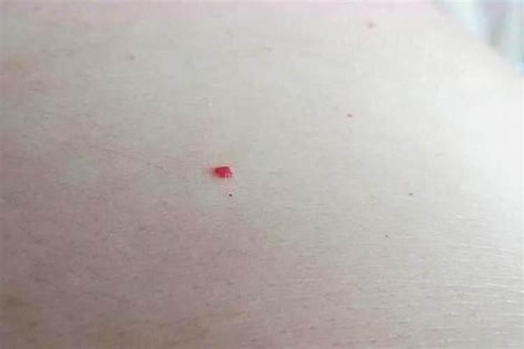 痣自己掉了是什么意思？