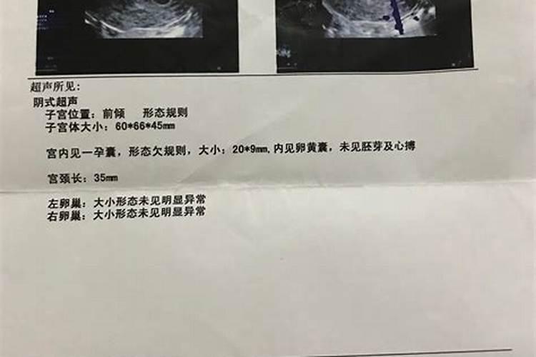 流产是选择 人流好还是药流好？