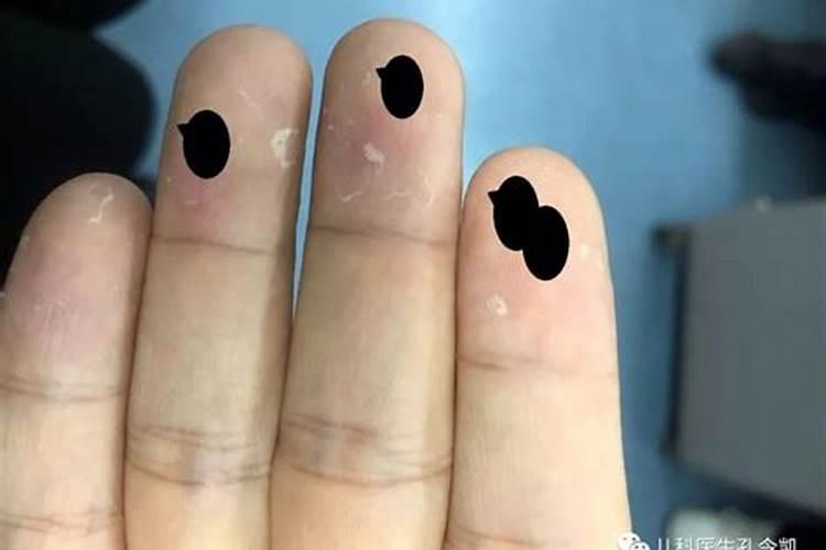 梦见手脱皮什么意思