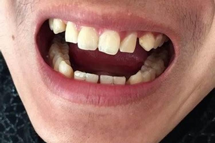 做梦梦到自己掉牙了是什么征兆？