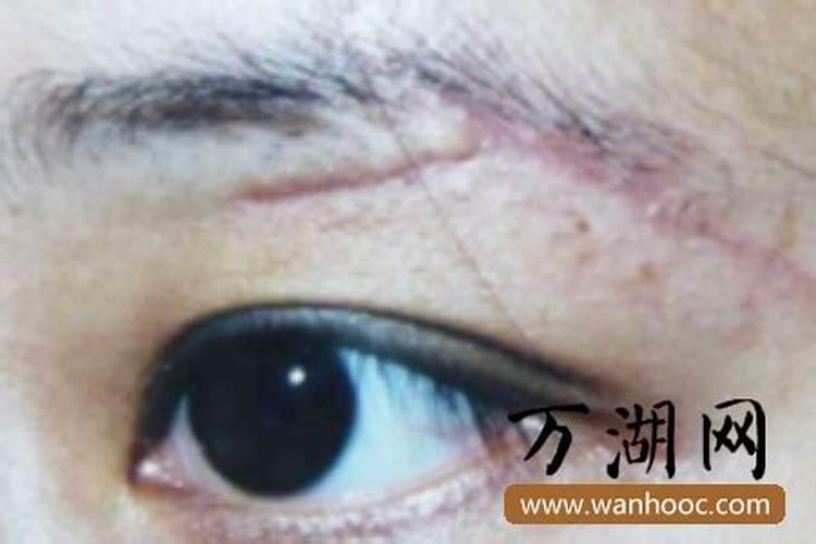 眉毛上有疤痕大富大贵 眉毛上有疤痕命运如何？