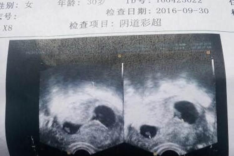 堕胎会影响运势么