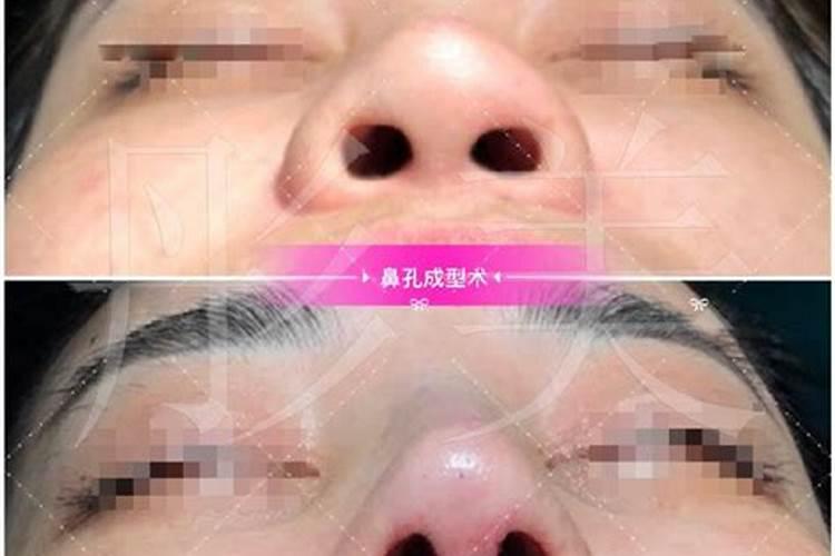 整容鼻子会改变运势吗,整容可以转运吗