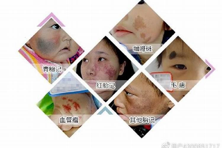 真童子的胎记长在什么位置
