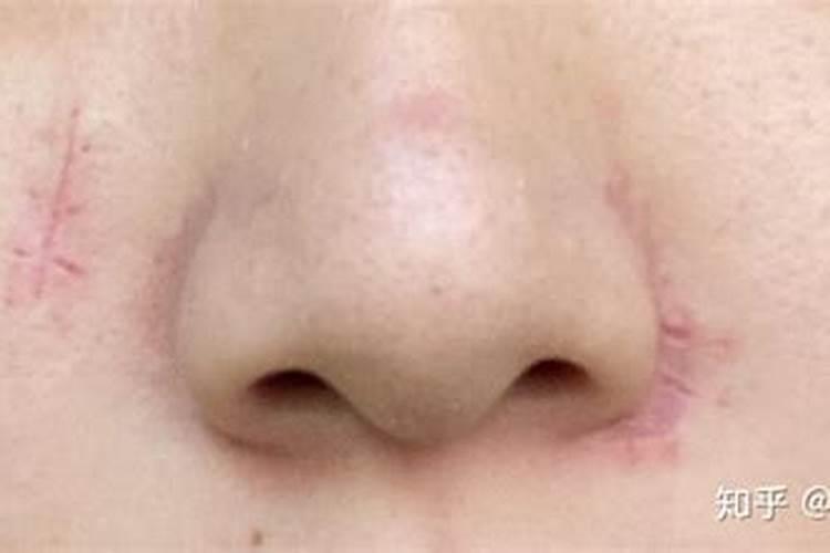 点痣后运气变了是真的吗 痣随便不能乱点？
