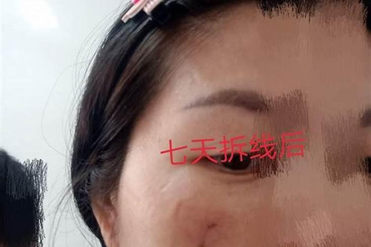 祛痣会影响运程吗