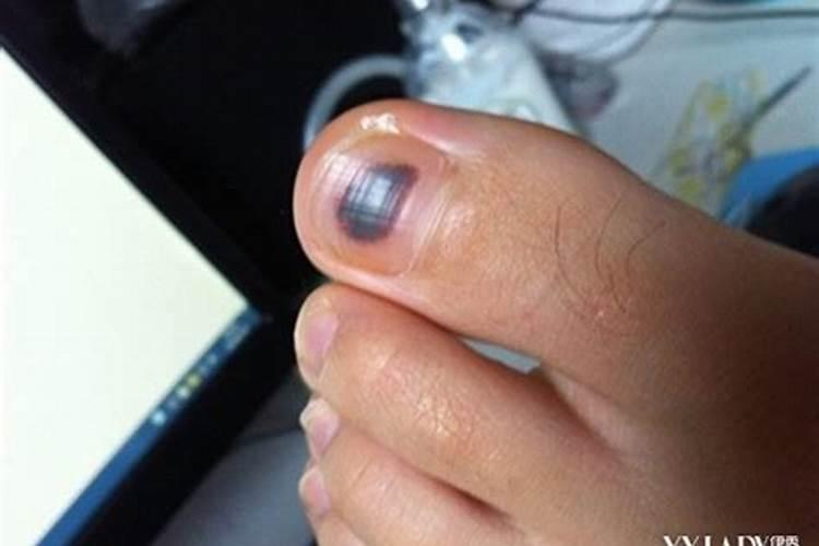 梦见脚趾甲盖掉了怎么回事