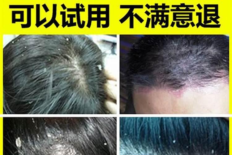 头上有头癣在佛教上算什么